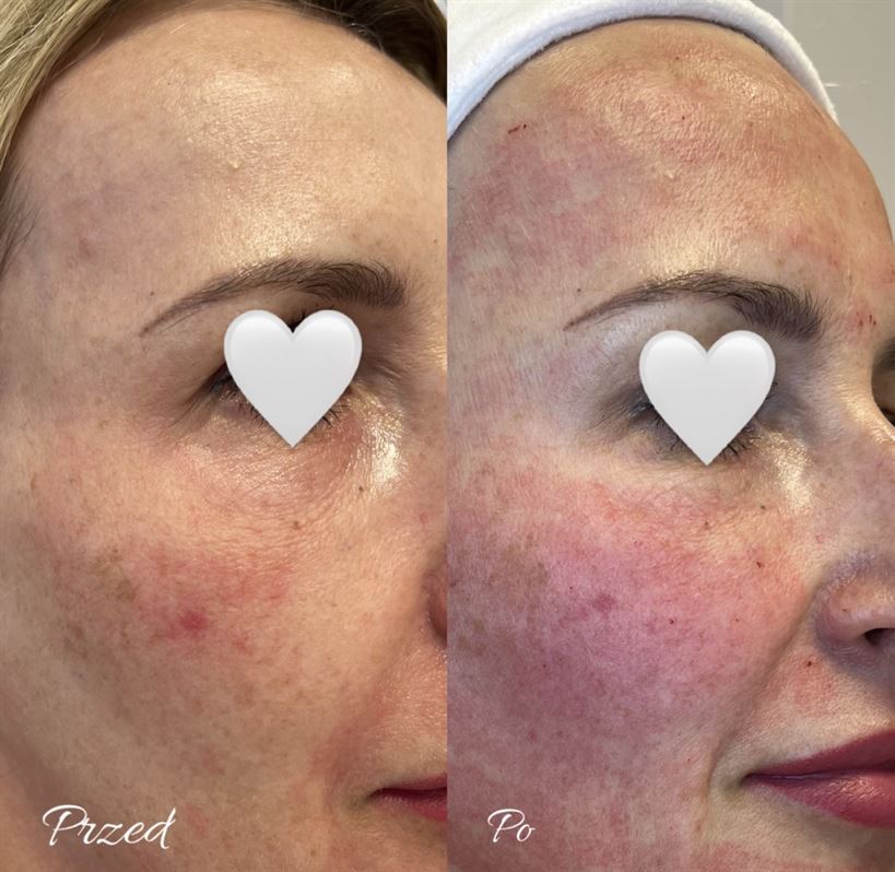 radiofrekwencja mikroiglowa efekty