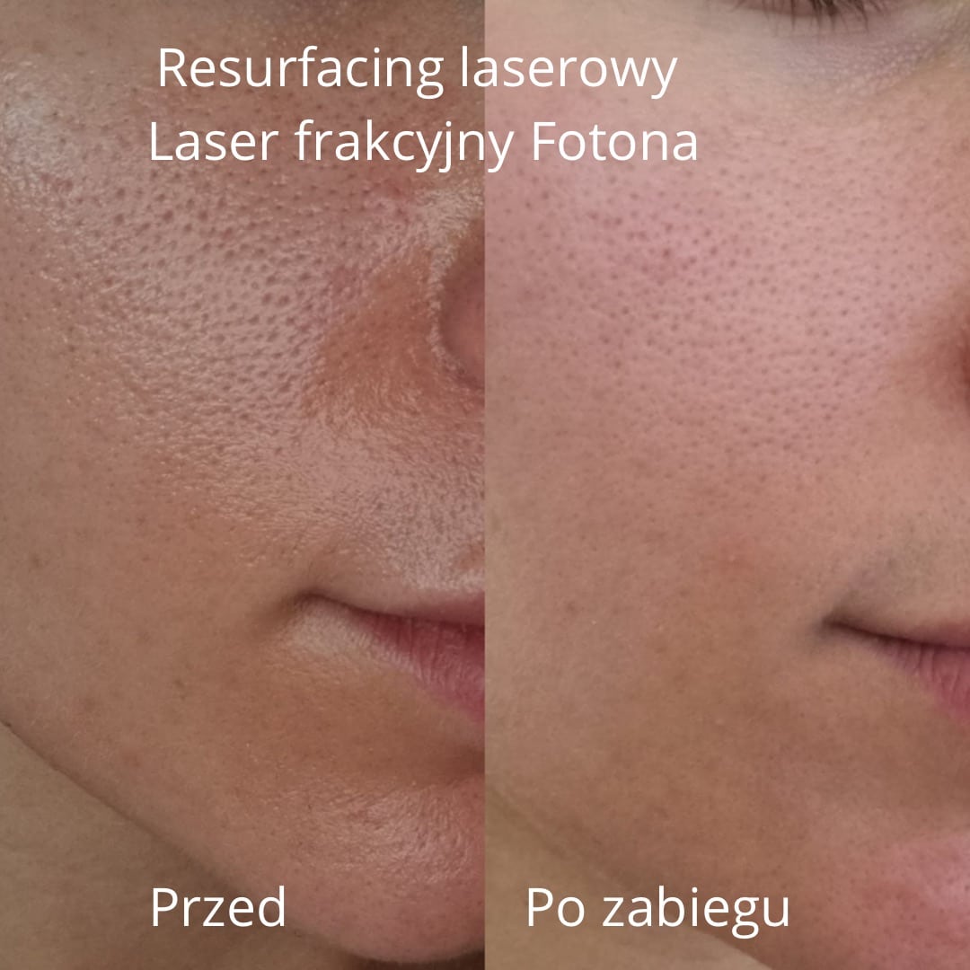 resurfacing laserowy fotona przed i po