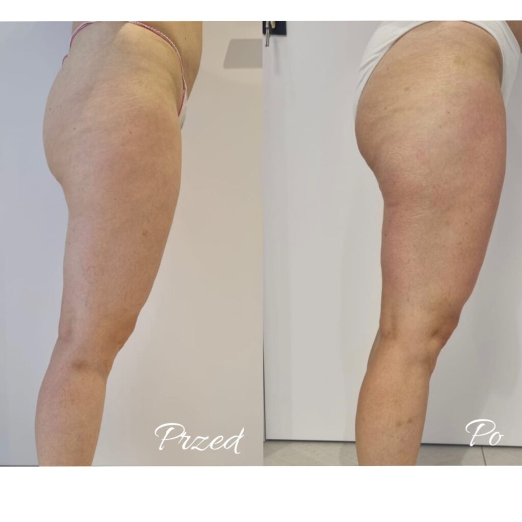 zabiegi na pośladki