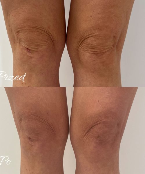 hifu na kolana efekty przed i po
